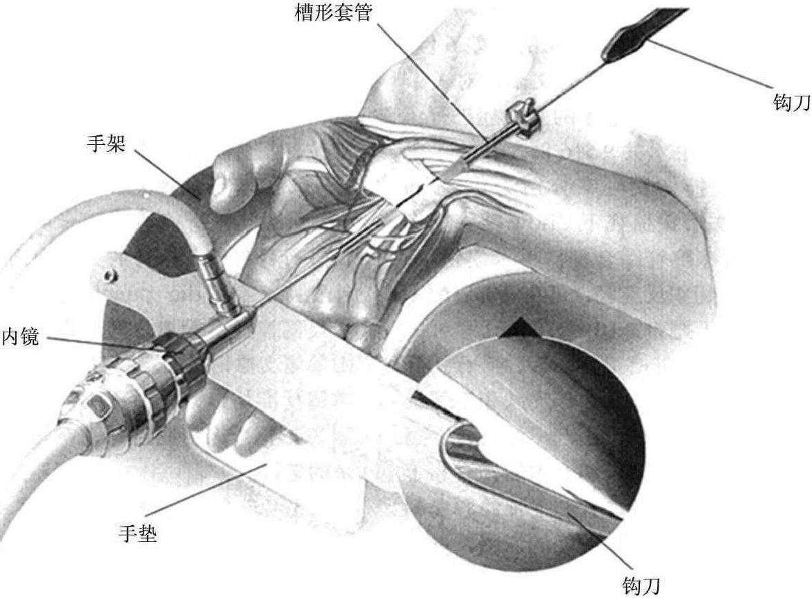 第三節(jié) 腕關節(jié)鏡